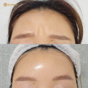 khách hàng trước và sau khi sử dụng Hitox 100