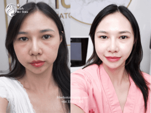 Da chảy sệ cho over filler - Tiêm filler quá đà và tan 5 lần