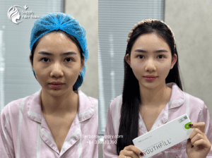 Thăng hạng nhan sắc khi cân chỉnh bằng filler