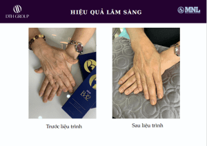 Hiệu quả sau khi sử dụng Save B32
