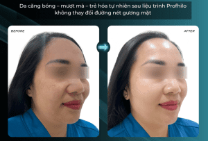 hiệu quả sử dụng Profhilo