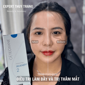 Khách hàng sau khi sử dụng Teoxane 2