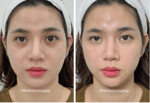 Trước và sau khi sd Teoxane 1